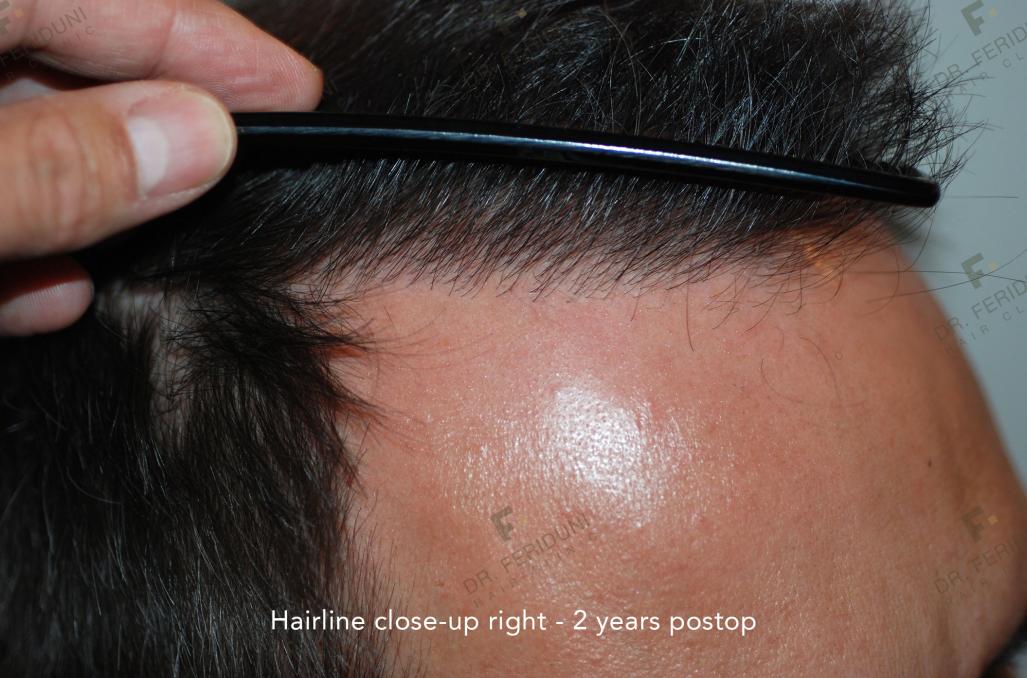 Image uploaded by: Dr Feriduni Hair Clinic