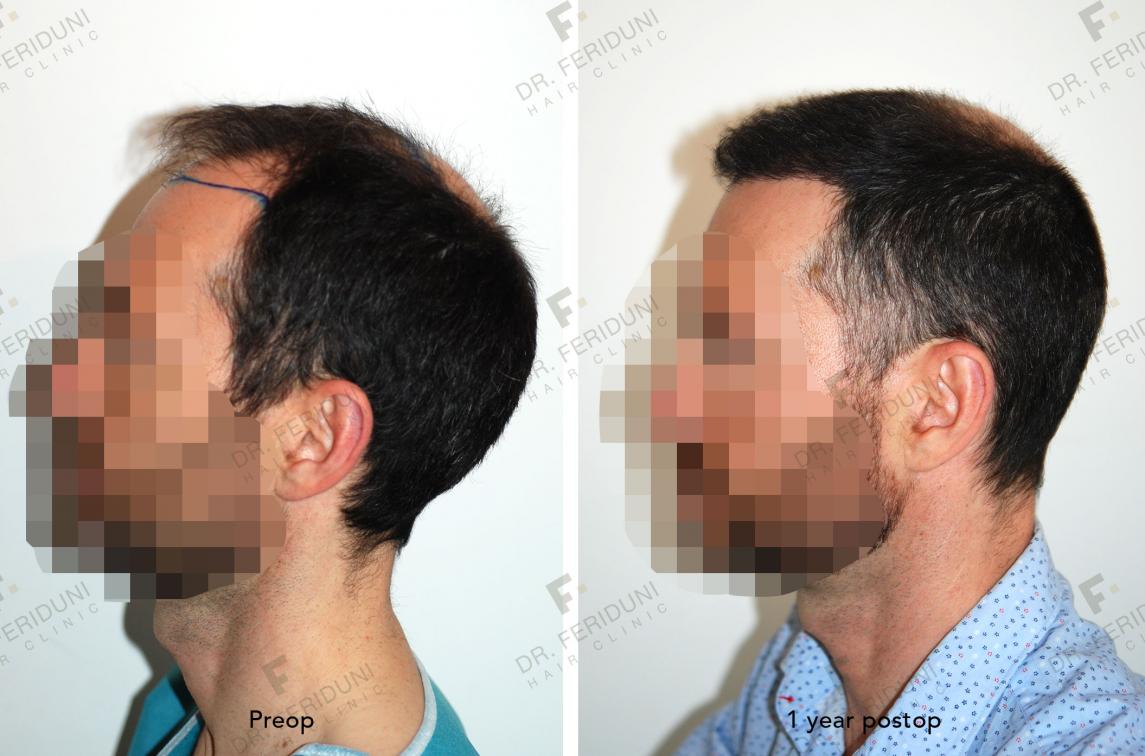 Image uploaded by: Dr Feriduni Hair Clinic