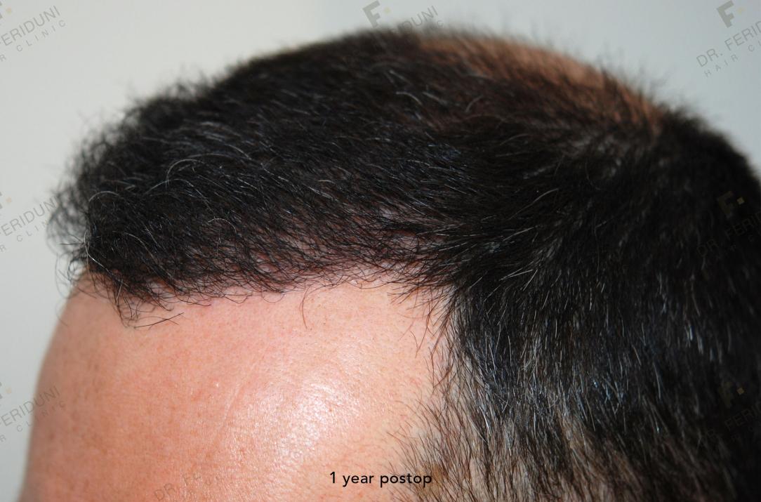 Image uploaded by: Dr Feriduni Hair Clinic