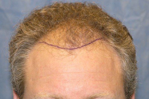 Click image for larger version
Name: 03_before-hair-transplant.jpg
Size: 57.2 KB
ID: 7410