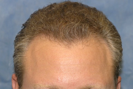 Click image for larger version

Name:	04_after-1st-hair-transplant.jpg

Size:	50.2 KB
ID:	7411