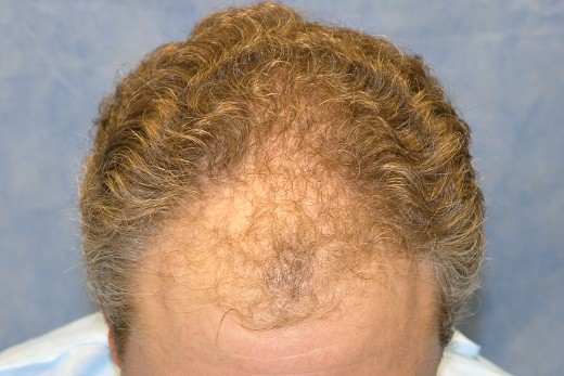Click image for larger version
Name: 05_before-hair-transplant-top-view.jpg
Size: 58.4 KB
ID: 7412