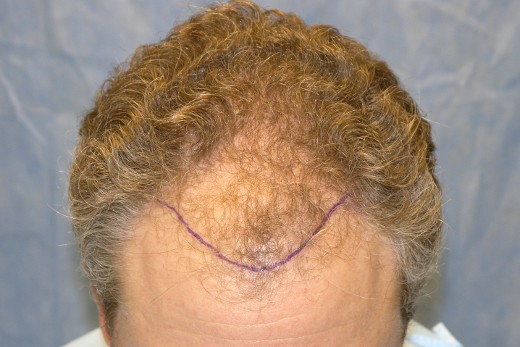 Click image for larger version
Name: 06_hairline-position.jpg
Size: 56.7 KB
ID: 7413