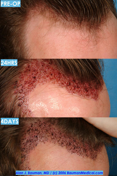Click image for larger version

Name:	hairline-healing.jpg

Size:	65.7 KB
ID:	866