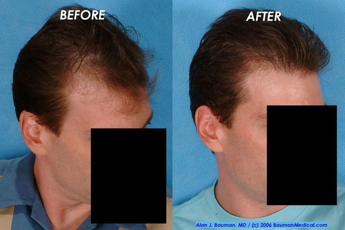 Click image for larger version

Name:	hairline-tp_side.jpg

Size:	64.3 KB
ID:	867