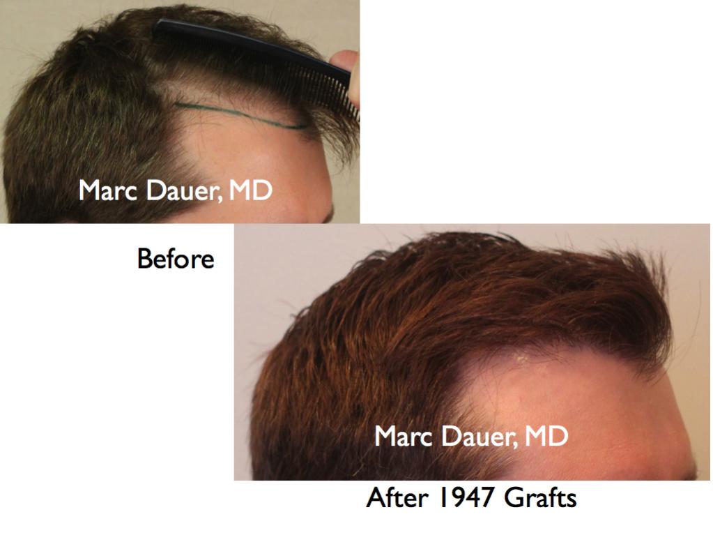 Click image for larger version

Name:	Hair Transplant Slides5.126.jpg

Size:	59.9 KB
ID:	25568