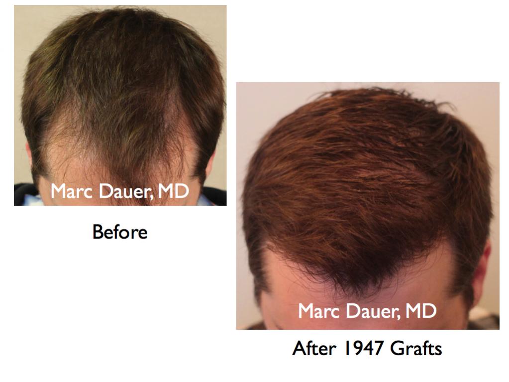 Click image for larger version

Name:	Hair Transplant Slides5.127.jpg

Size:	66.5 KB
ID:	25569