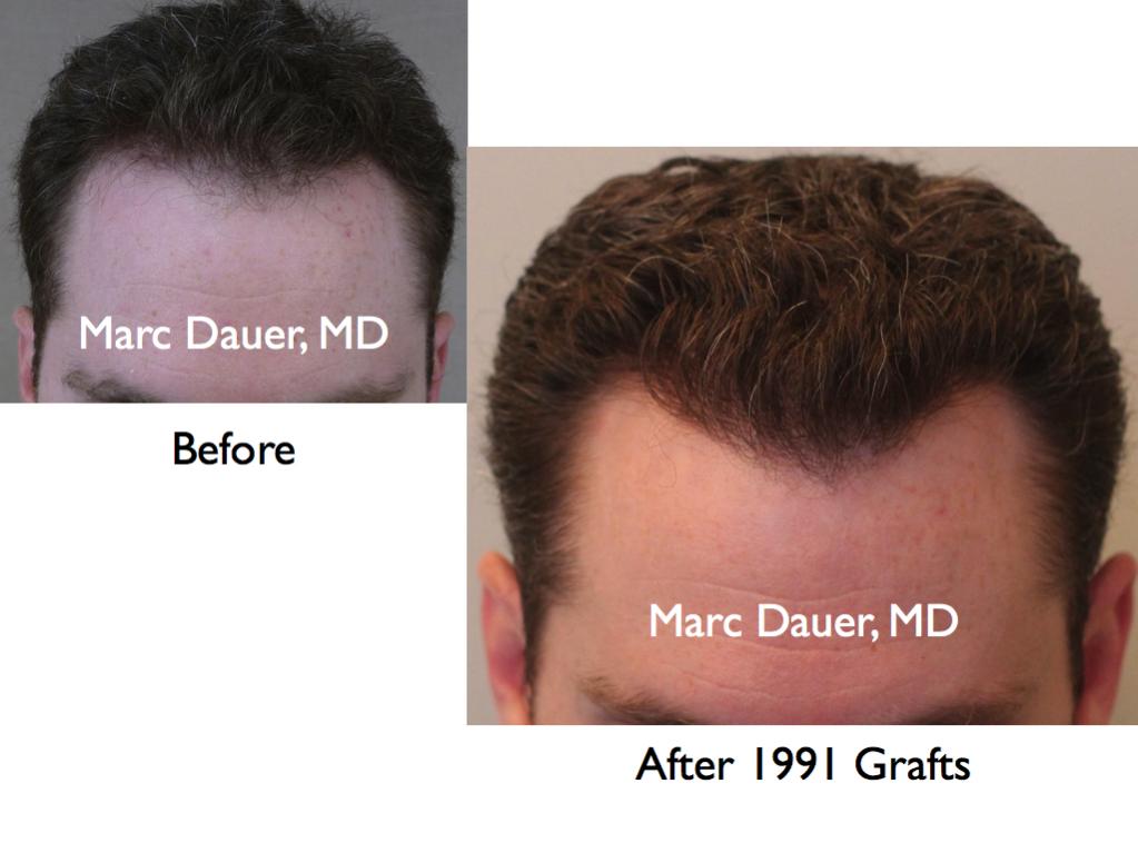 Click image for larger version

Name:	Hair Transplant Slides5.129.jpg

Size:	61.0 KB
ID:	25570