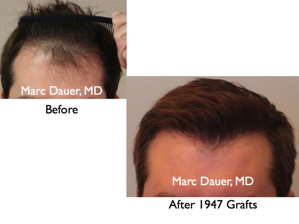 Click image for larger version

Name:	Hair Transplant Slides5.124.jpg

Size:	54.8 KB
ID:	25566