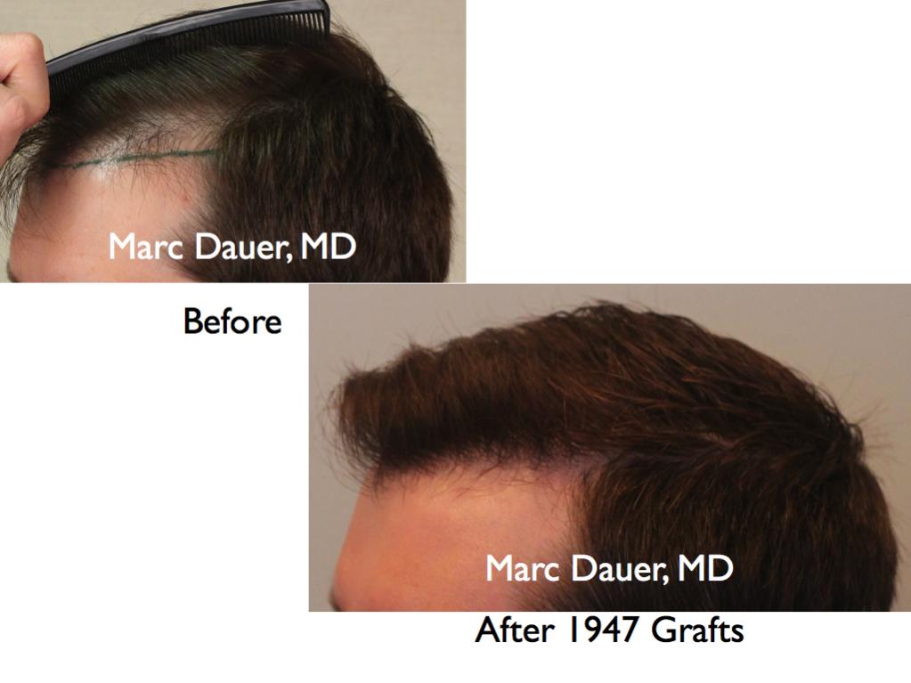 Click image for larger version

Name:	Hair Transplant Slides5.125.jpg

Size:	56.2 KB
ID:	25567