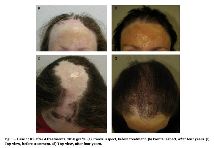 Click image for larger version

Name:	Fig4--Burns 2010--700x700--E--Burnt woman.jpg

Size:	47.6 KB
ID:	9361