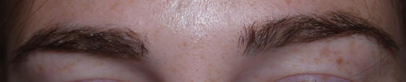 After eyebrow hair transplant.