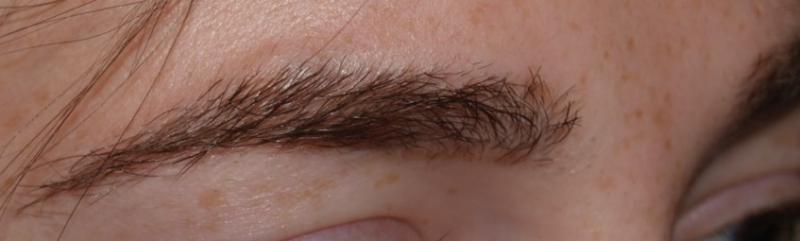 After eyebrow hair transplant.