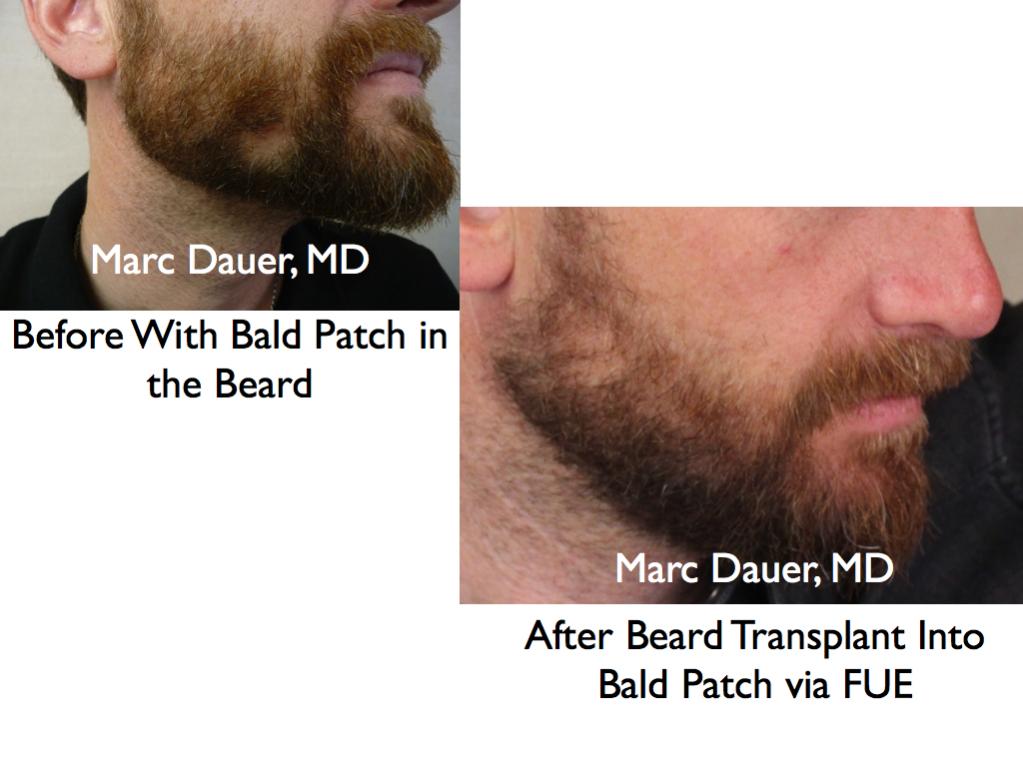 Click image for larger version

Name:	Hair Transplant Slides beard.123.jpg

Size:	69.0 KB
ID:	25564