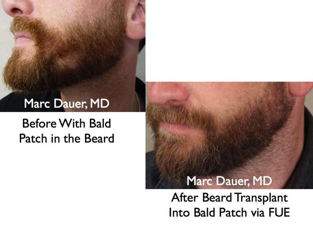 Click image for larger version

Name:	Hair Transplant Slides beard.124.jpg

Size:	76.5 KB
ID:	25565