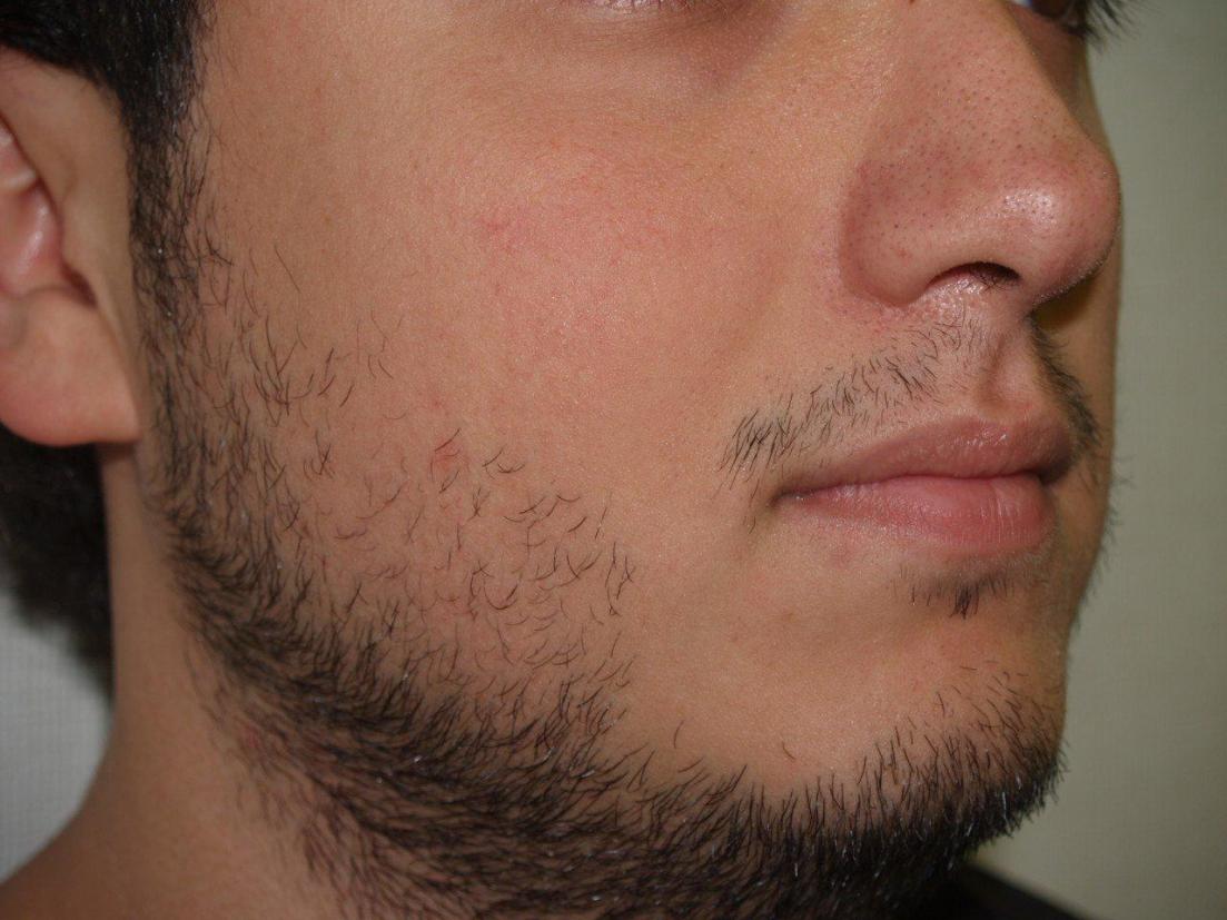 Click image for larger version

Name:	Before Beard.jpg

Size:	98.1 KB
ID:	9503