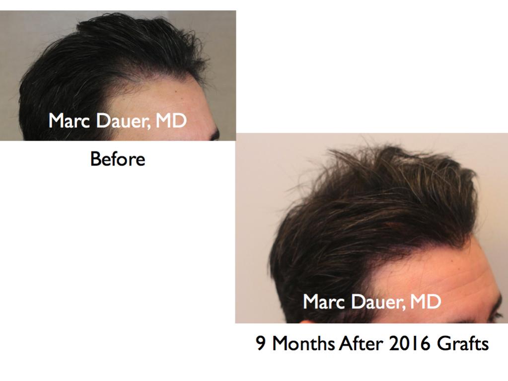 Click image for larger version

Name:	Hair Transplant Slides.109.jpg

Size:	50.7 KB
ID:	25471