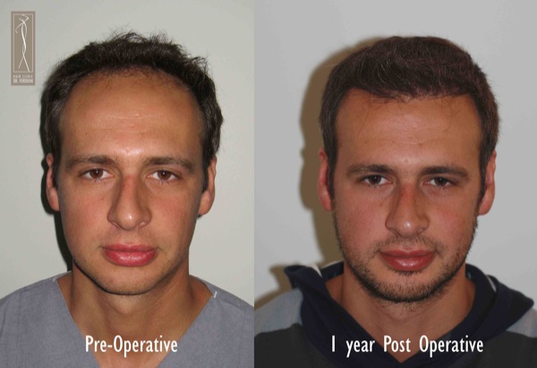 Click image for larger version
Name: Patient 1 - pre and post.jpg
Size: 57.5 KB
ID: 4792