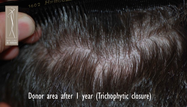 Click image for larger version
Name: Patient 1 - donor area post-operative.jpg
Size: 73.7 KB
ID: 4795