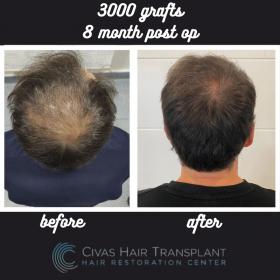 Procedure: FUE Hair Transplant 
Number of grafts: 3000 Grafts 
Results: 8 Months Post-op