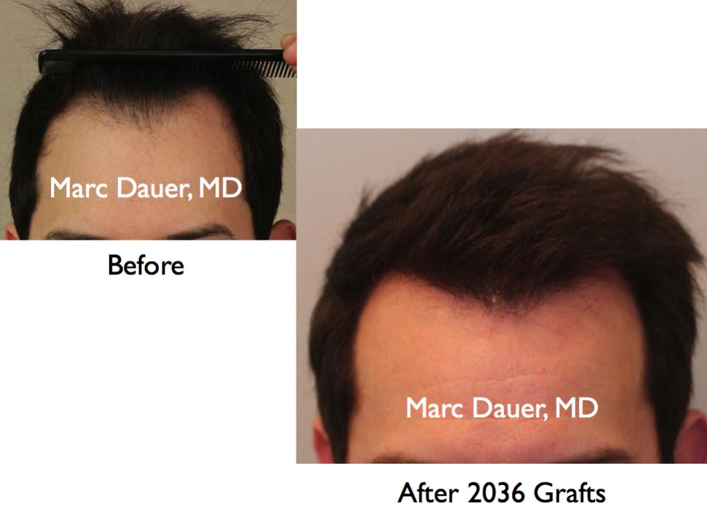 Click image for larger version

Name:	Hair Transplant Slides.133.jpg

Size:	51.8 KB
ID:	25613