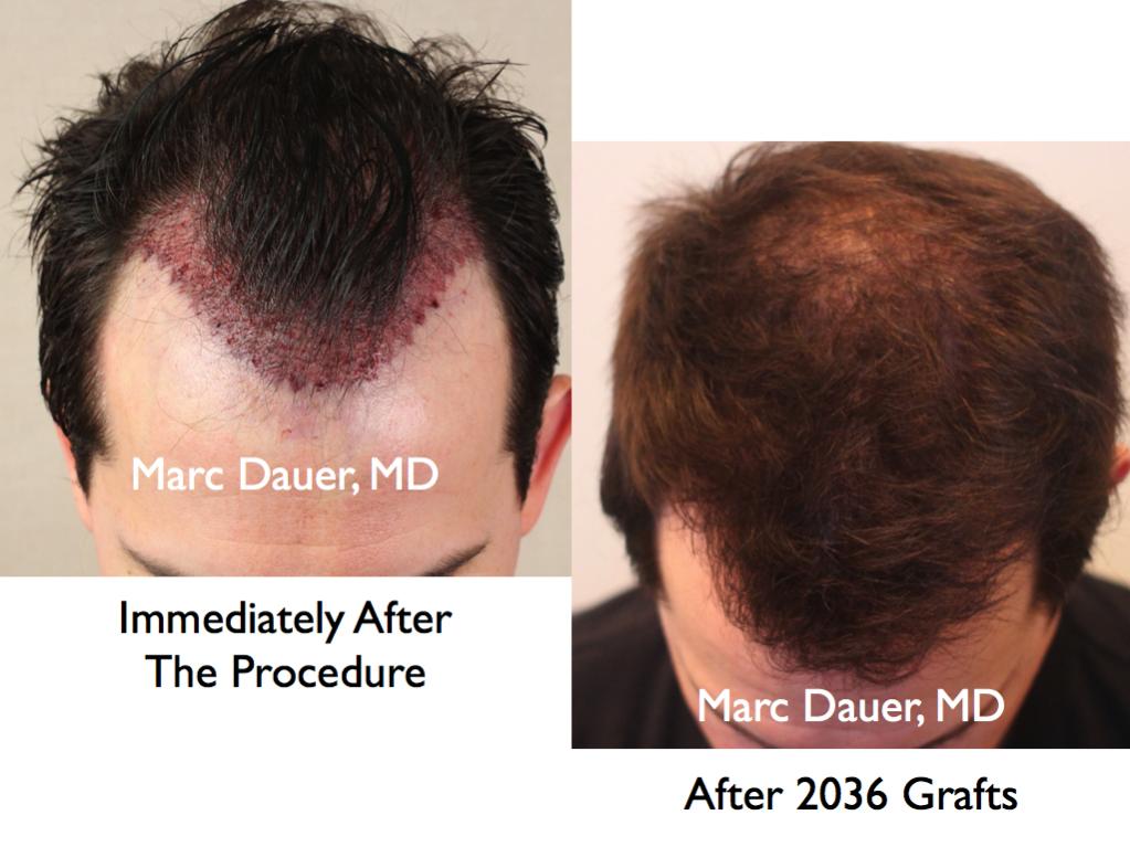 Click image for larger version

Name:	Hair Transplant Slides.136.jpg

Size:	78.6 KB
ID:	25616