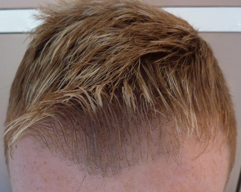 The secret to a thick hairline...... (Pictures included) 