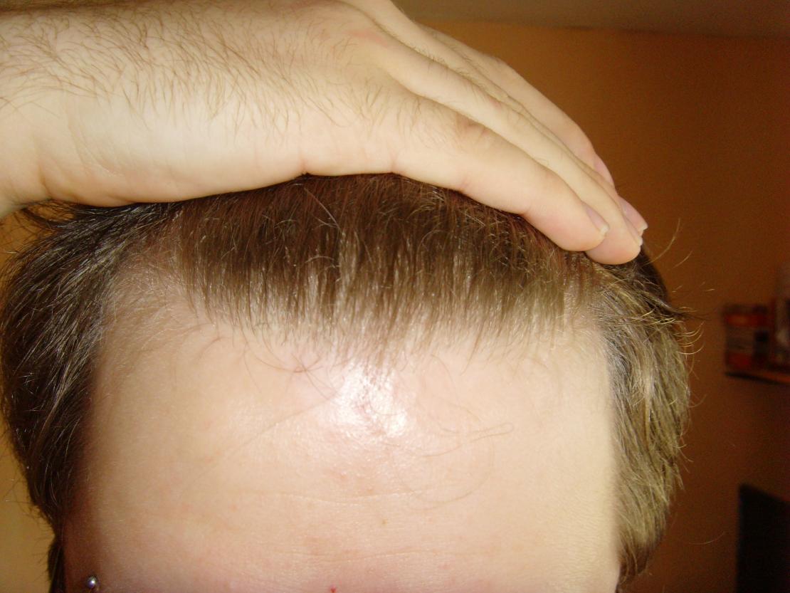 22 And Hair Thinning BaldTruthTalkcom