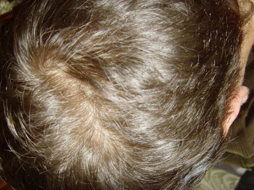 22 And Hair Thinning Baldtruthtalk Com