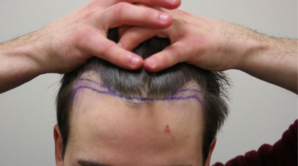 Ottawa Hair Transplant - Dr. Rahal / 1441 Grafts / 13 Mo. Post-op -  