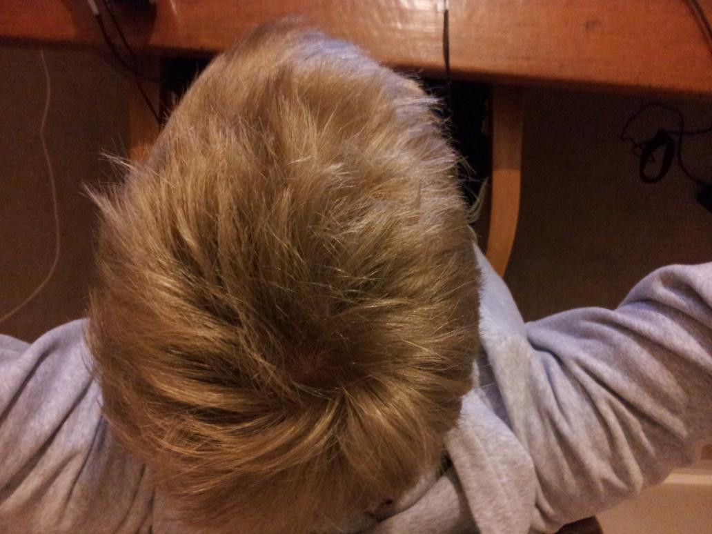 Cowlick Hair Or The Beginnings Of Balding Baldtruthtalk Com