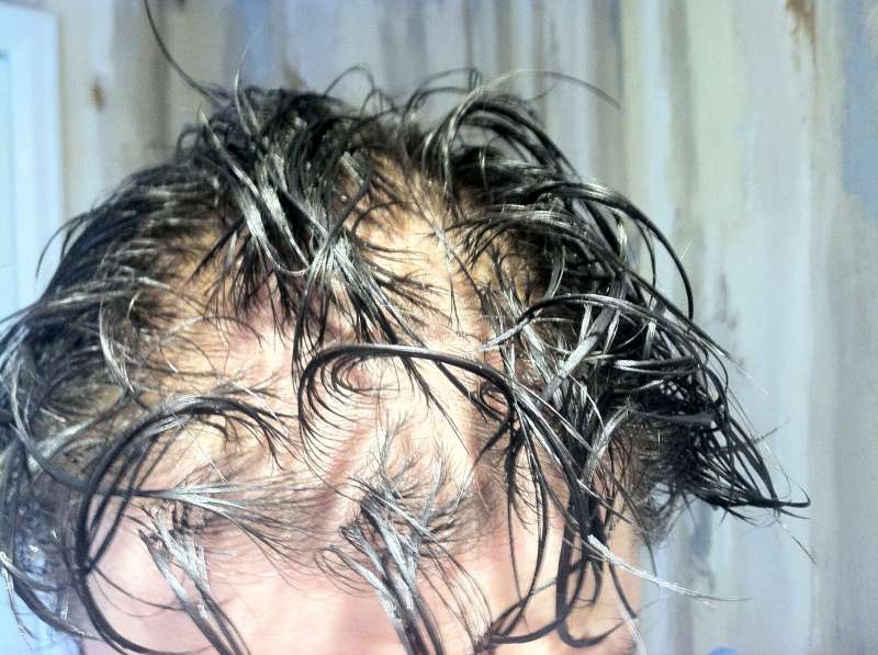Six Years On Oral Dutasteride Diffuse Balder Maintaining From