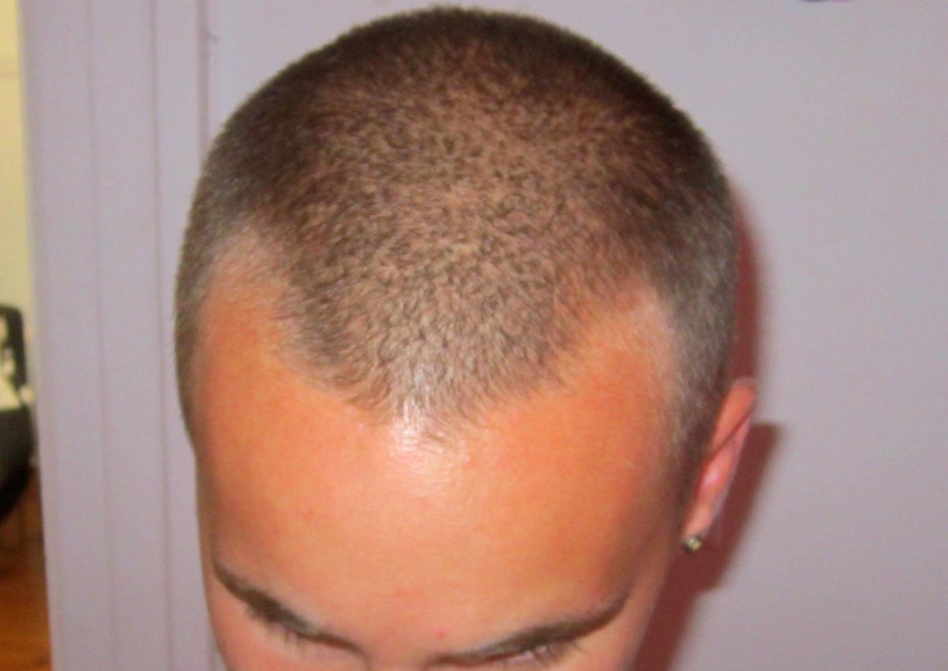 What is an M-Shaped Hairline, and Can It Be Fixed?