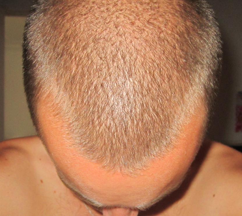 M Shaped Hairline Baldtruthtalk Com