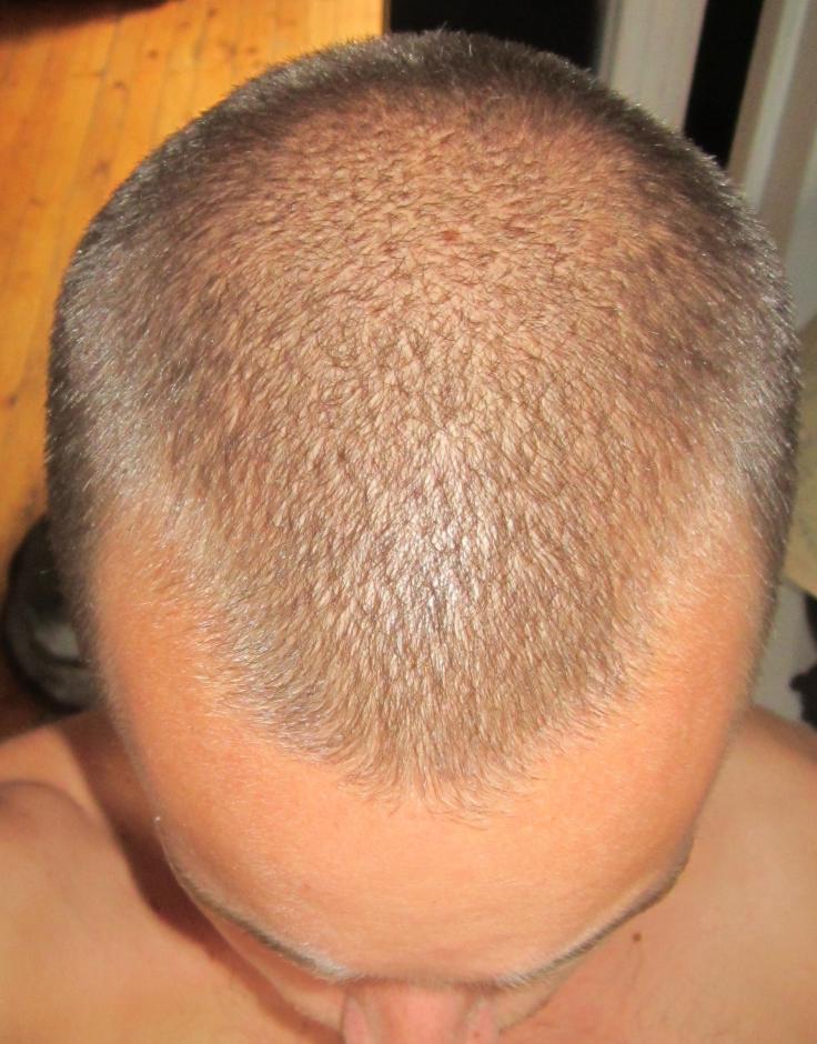 M Shaped Hairline Baldtruthtalk Com