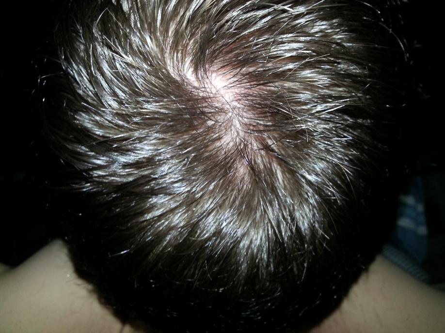 Hair Loss On Crown Permanent Baldtruthtalk Com