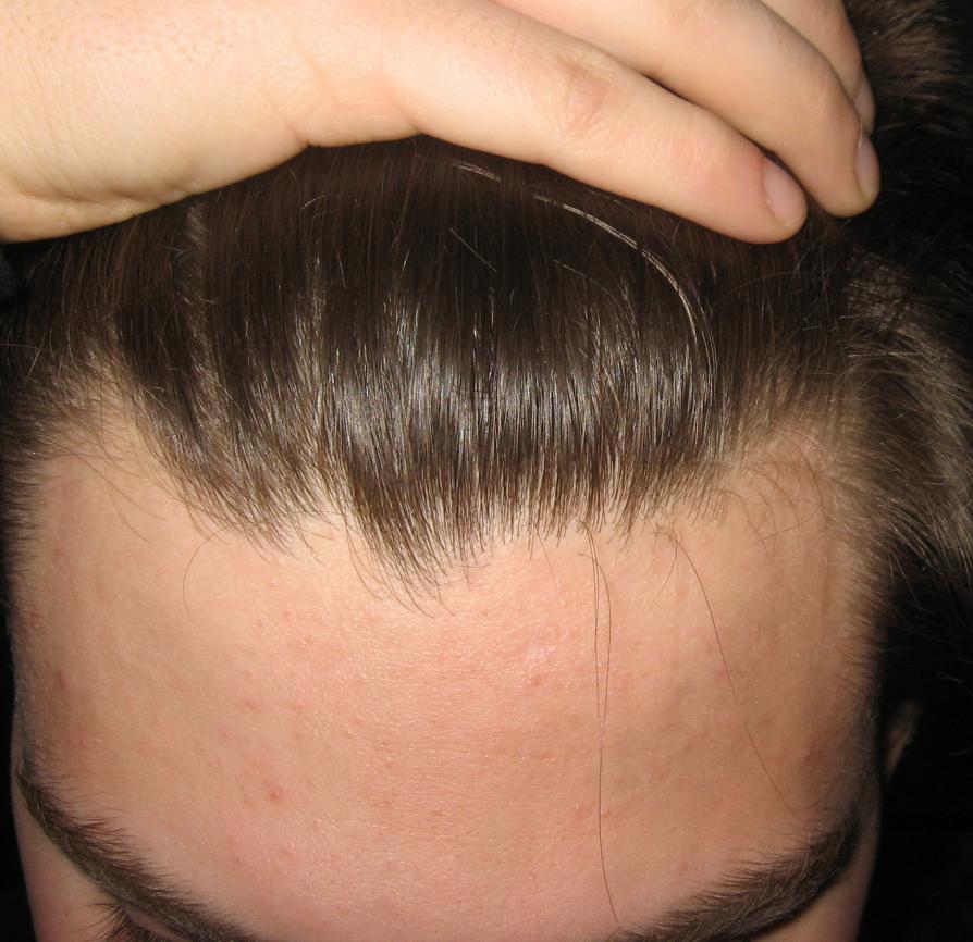 Is hairline receding my help Combating a