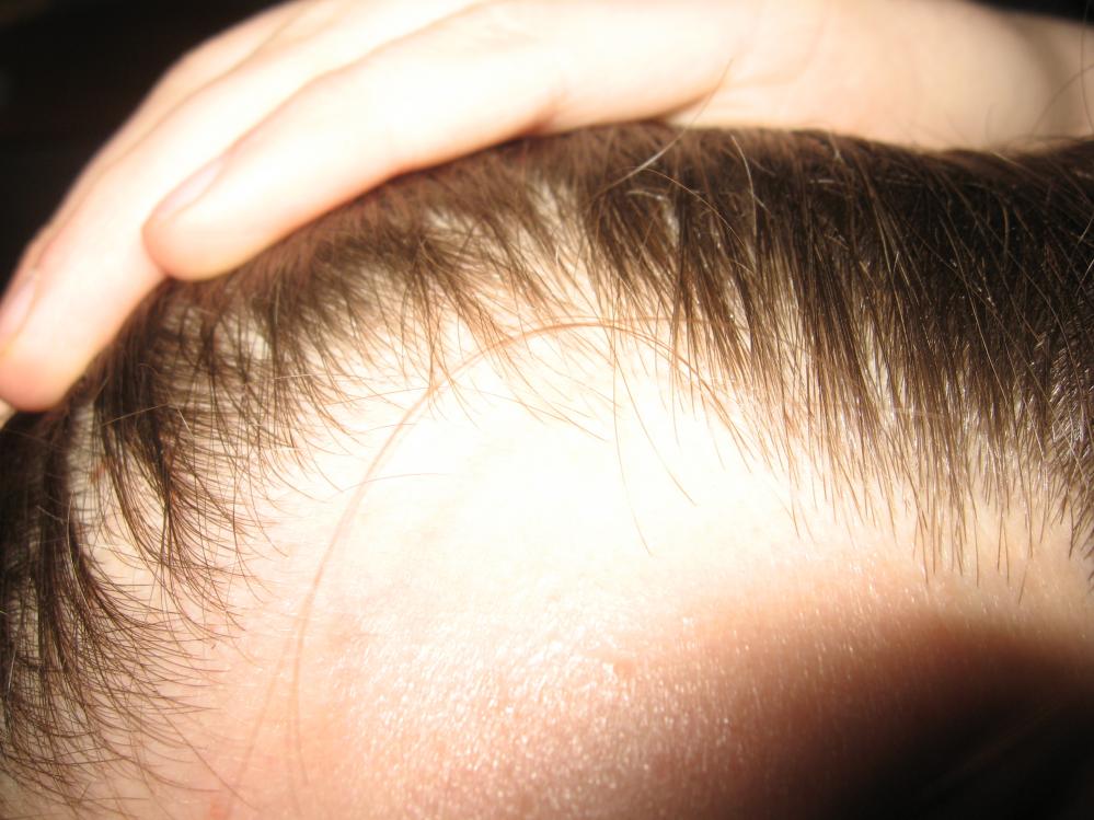 How To Find Out If Your Hairline Is Receding Best Hairstyles 2017