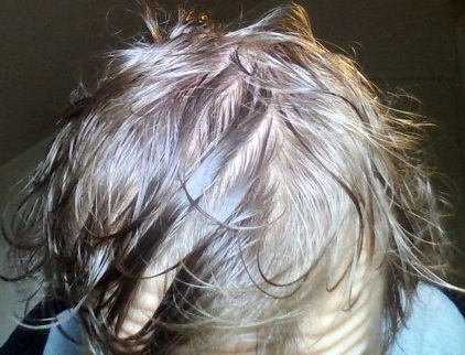Thinning Or Not Baldtruthtalk Com