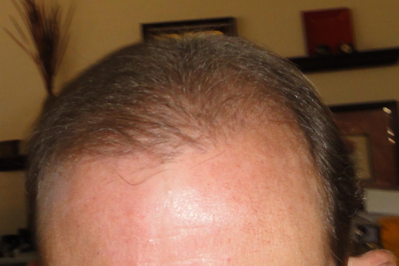 Click image for larger version

Name:	11.12.12 Hair Post Op 009.jpg

Size:	86.2 KB
ID:	17593