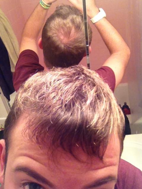 21 Year Old Male Thinning Baldtruthtalk Com