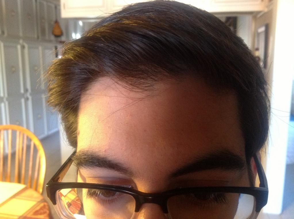 Thinning Crown But Hairline Is Not Receding Baldtruthtalk Com