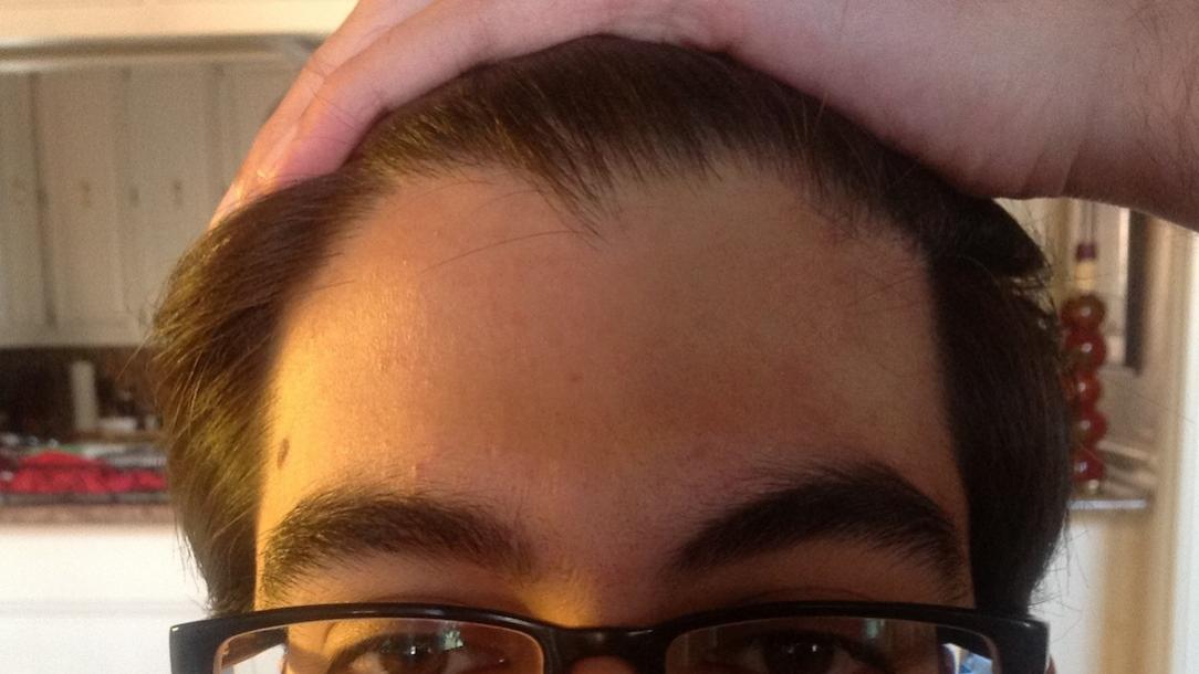 Thinning Crown But Hairline Is Not Receding Baldtruthtalk Com