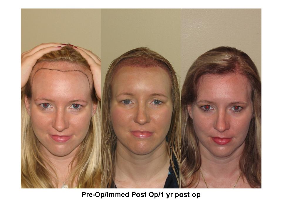 Lowering Hairline On Female Pt Dr Ron Shapiro Baldtruthtalk Com