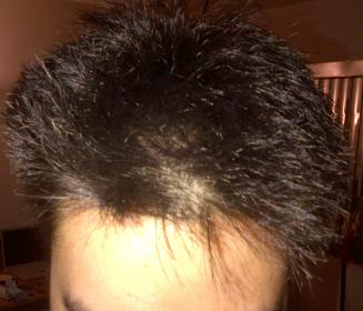 Went From Thick Full Head Of Hair To Thin And Balding In 3 Months