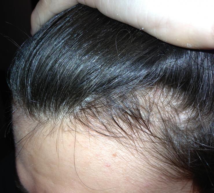 Is This Telogen Effluvium Or Mpb Baldtruthtalk Com