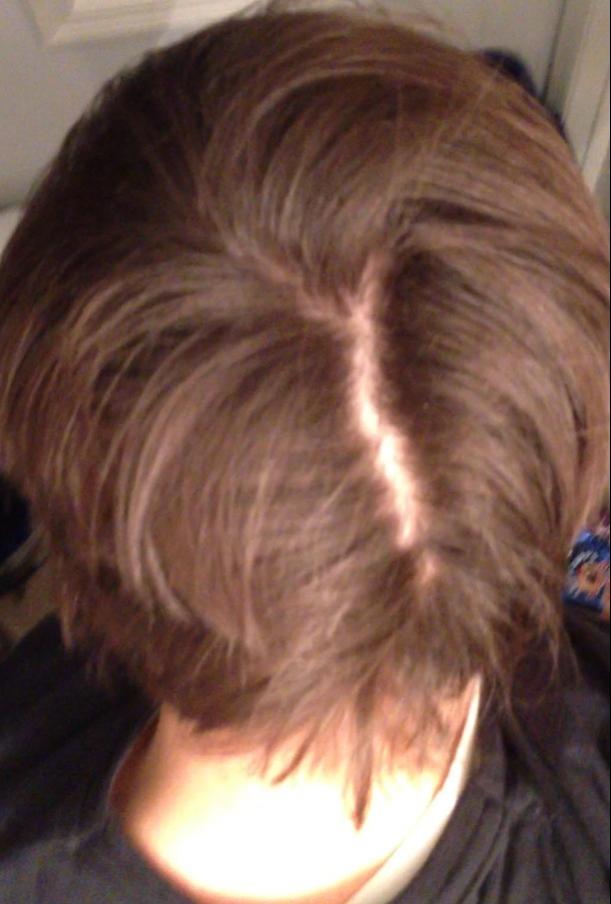 Is This Telogen Effluvium Or Mpb Baldtruthtalk Com