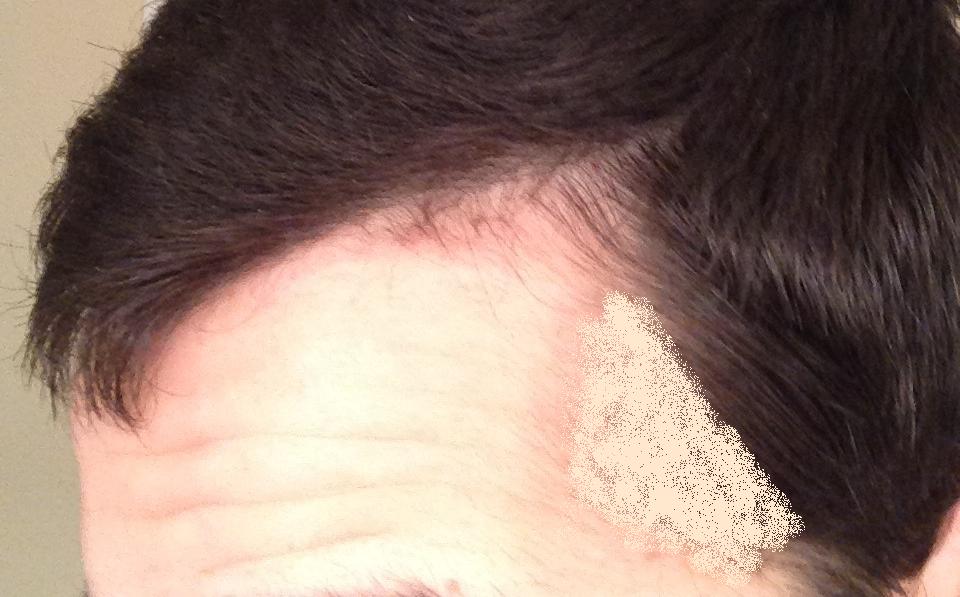 Temple Hairloss Is Usually First Baldtruthtalk Com