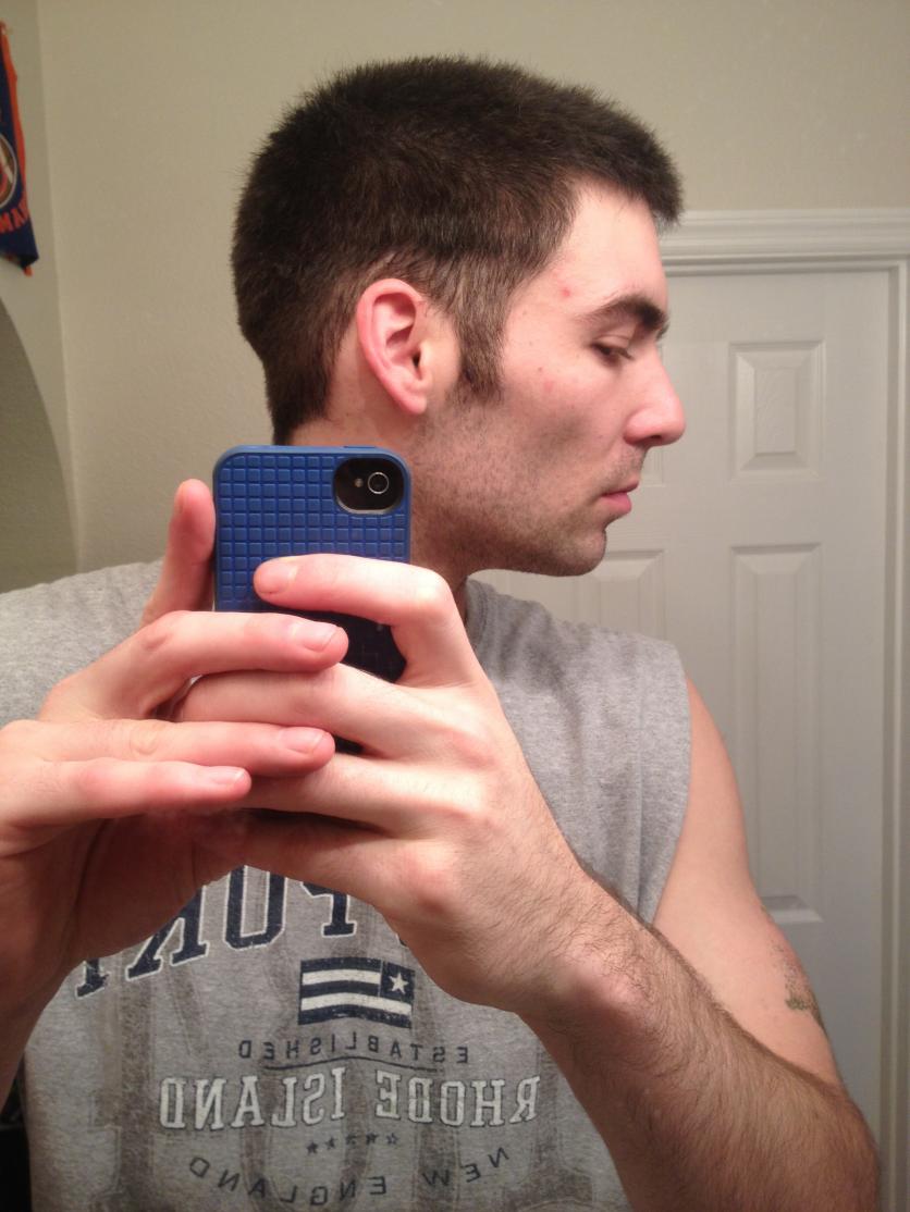 Losing Tons Of Hair Only On The Sides Of My Head BaldTruthTalkcom
