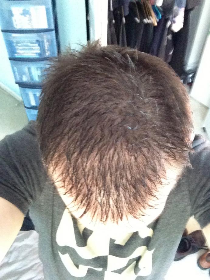 Accutane and balding, my story, advice needed 